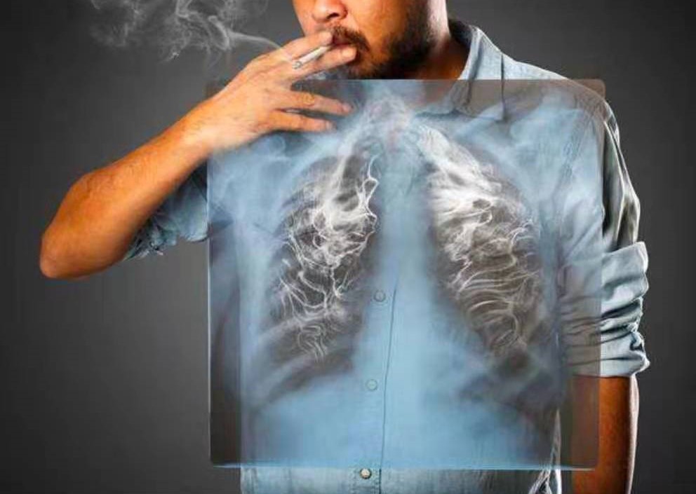 肺癌的致病因素科普