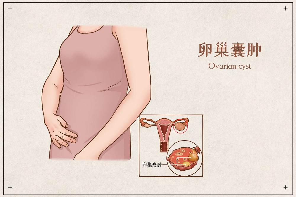 中医解读妇科疾病--卵巢囊肿